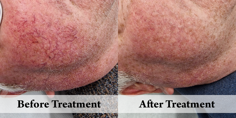 AW Veins Before & After 2.png