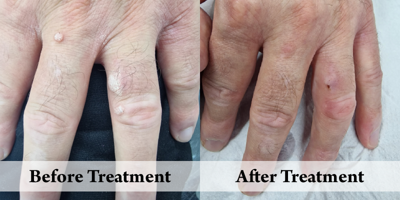 CB Wart Before & After.png