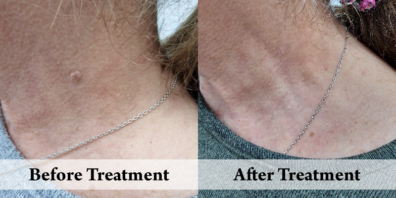 CC Wart Removal-Cryo Before & After.png