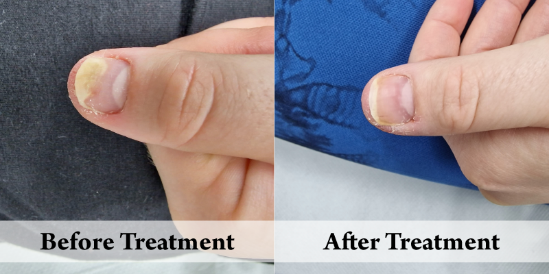 CK Fungal Nail-Before & After.png