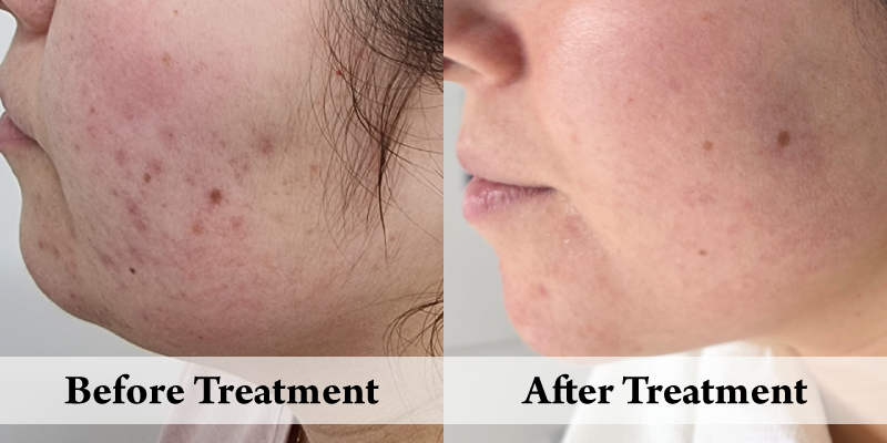 Acne Peels -Before and after Left Cheek.png