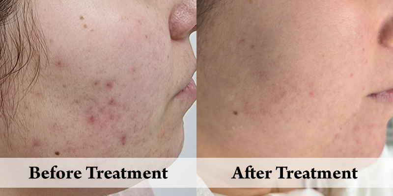 Acne Peels-Before and after Right Cheek.png