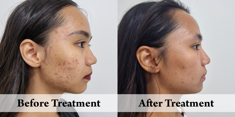Acne Peels - Right Cheek Before & After.png