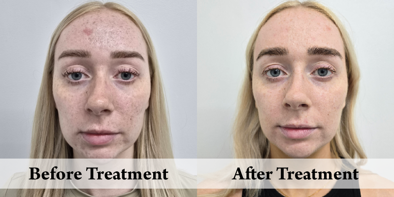 DermaPen-Before & After Front.png