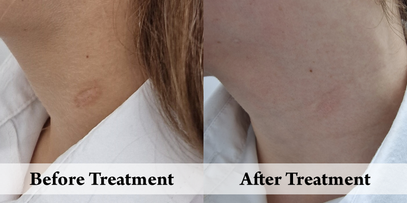 Scar Revision-Before & After.png
