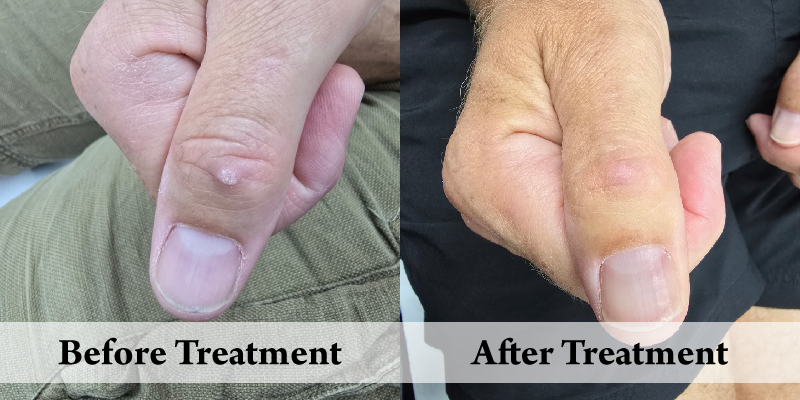 Wart Removal-Before & After.png