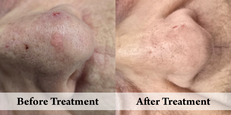 Wart-Before & After.png