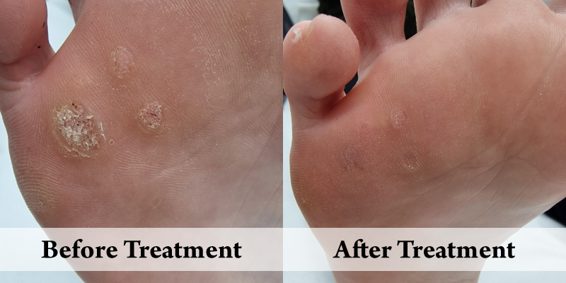 Wart removal-Ball of Foot Before & After.png