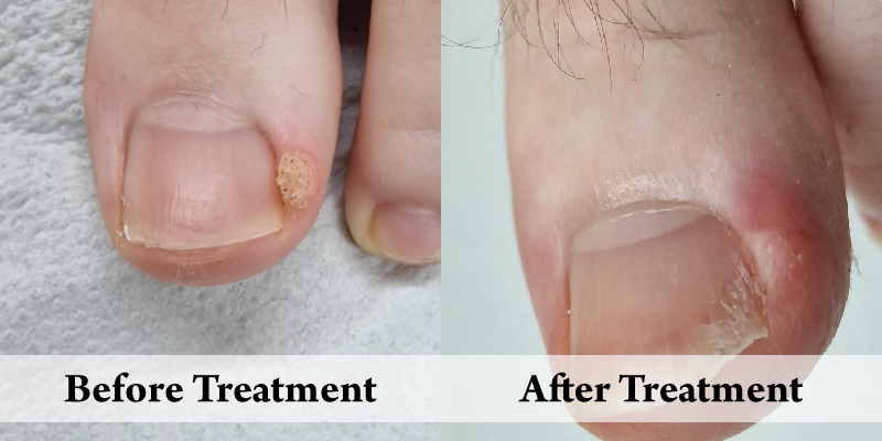 Wart Removal Big Toe-Before & After.png