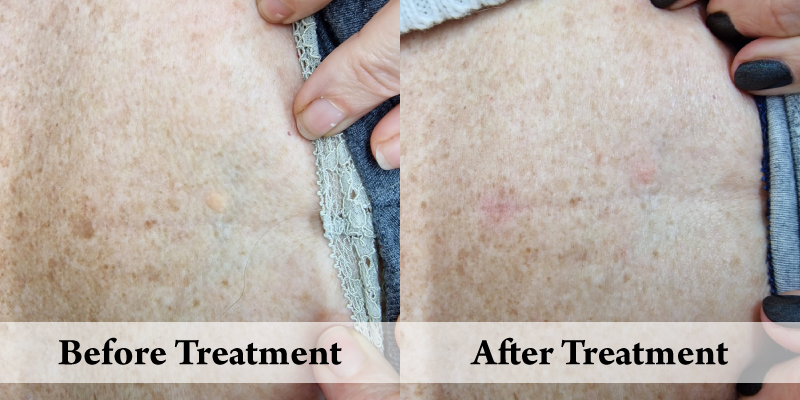 Cryotherapy-Before & After.png