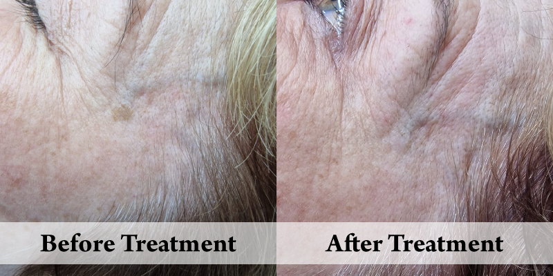 Cryotherapy -Before & After Temple.png