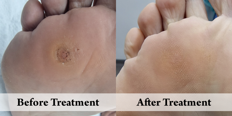Verrucae-Before & After.png
