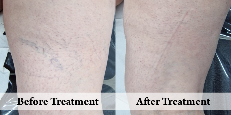 Veins-Before & After Back of thighs.png