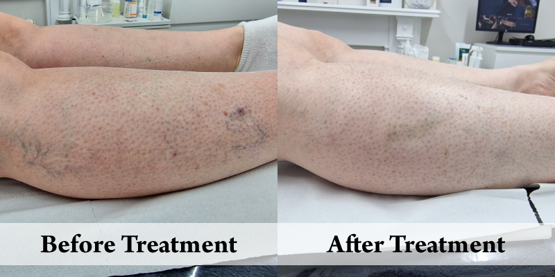 Veins-Before & After Lower Leg.png