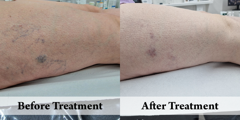 Veins-Before & After Thighs.png