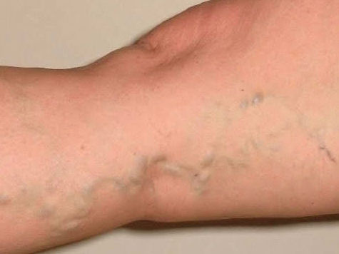 Before & AfterVaricose & Spider Veins — CPW Vein and Aesthetic Center