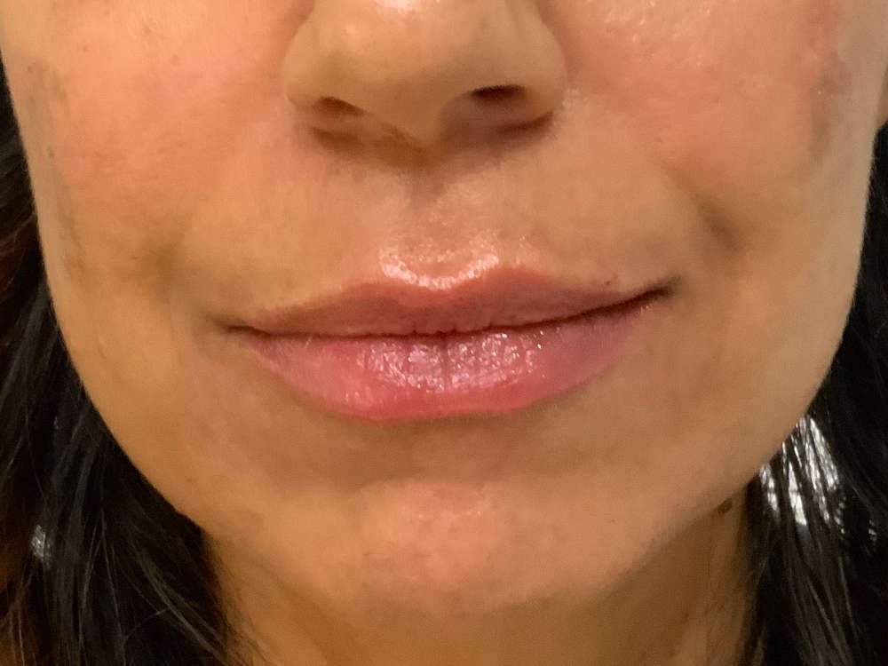 Before And Afterfiller Lips — Cpw Vein And Aesthetic Center