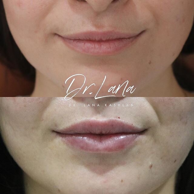 Kissing the weekend goodbye with a fresh pair of #drlanalips 💋 swipe ⬅️ to see that side view! 
#lips #lipfillers #fillers #dermatology #aesthetics #cosmeticsurgery
