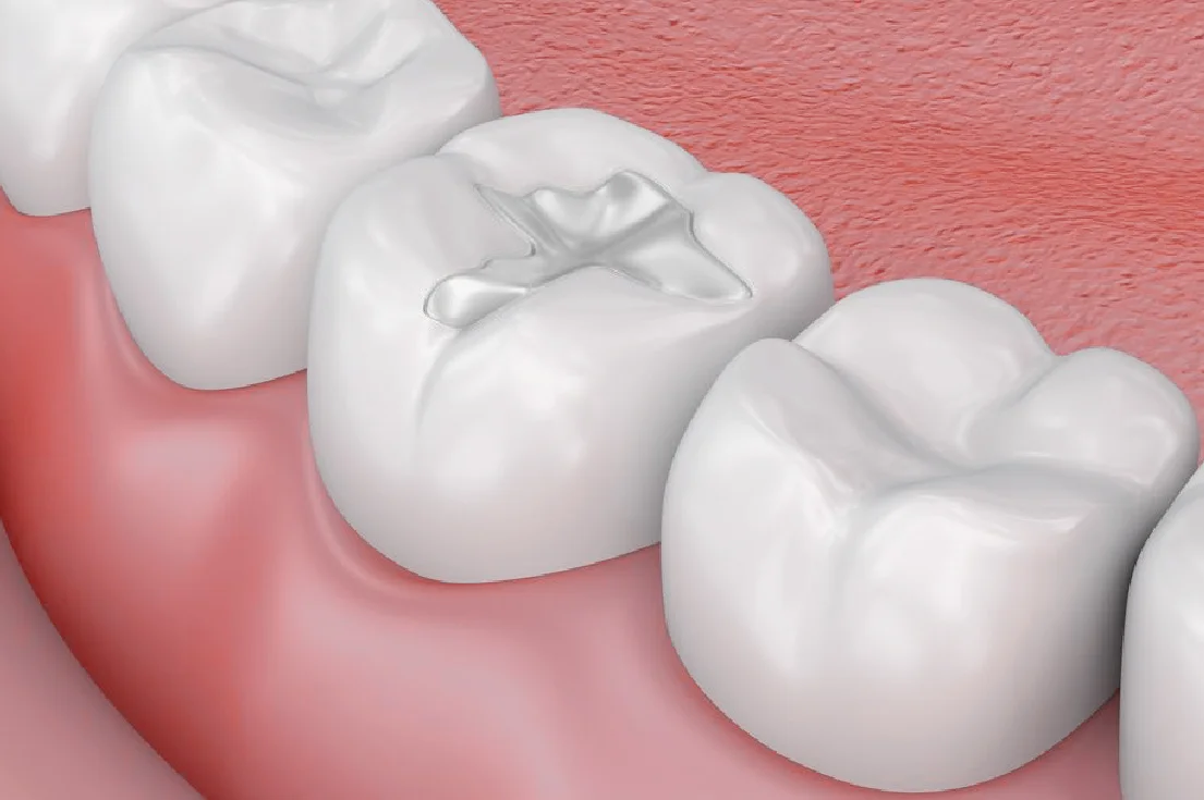 Composite-Fillings.jpg