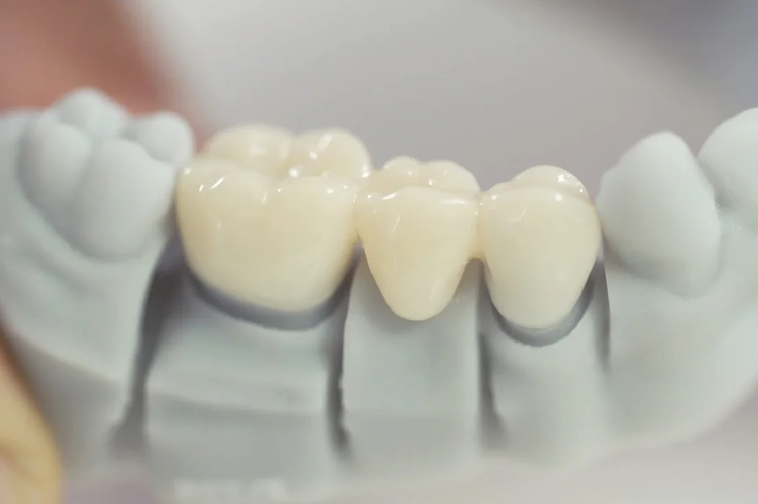 Dental-Crowns-and-Bridges.jpg