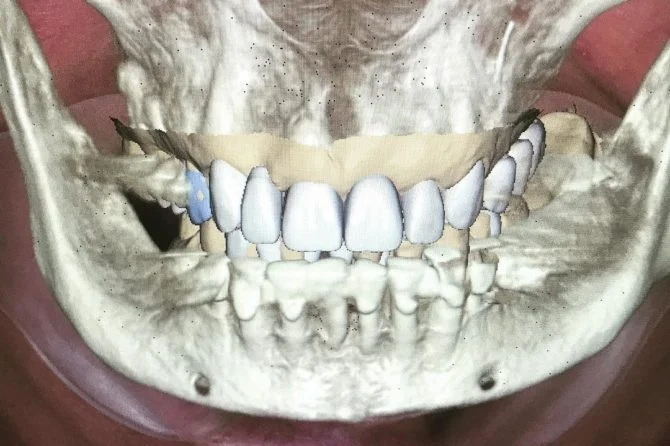 The secret to making the proper mouth guard