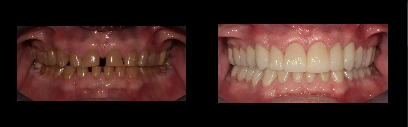 Before and After Full Mouth Crown Restoration with Dr. Bernal Soto in Costa Rica