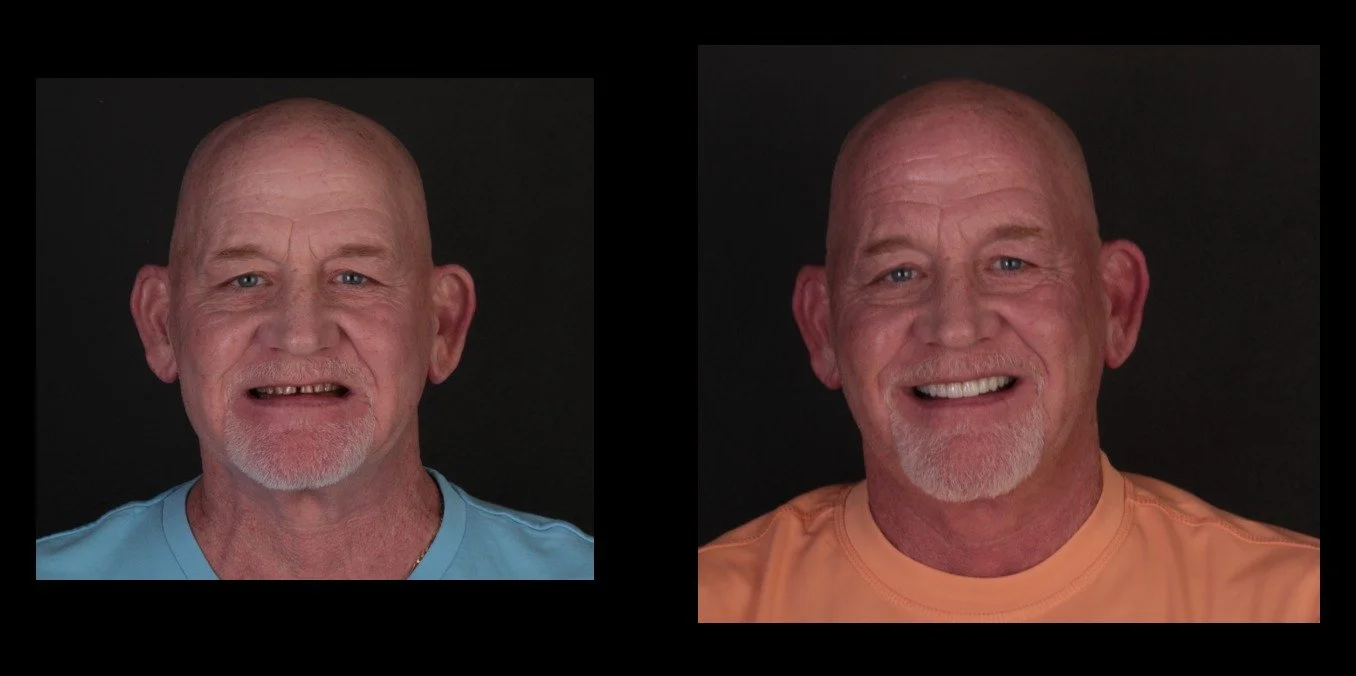 Dr. Bernal Soto Before and After Crowns in Costa Rica