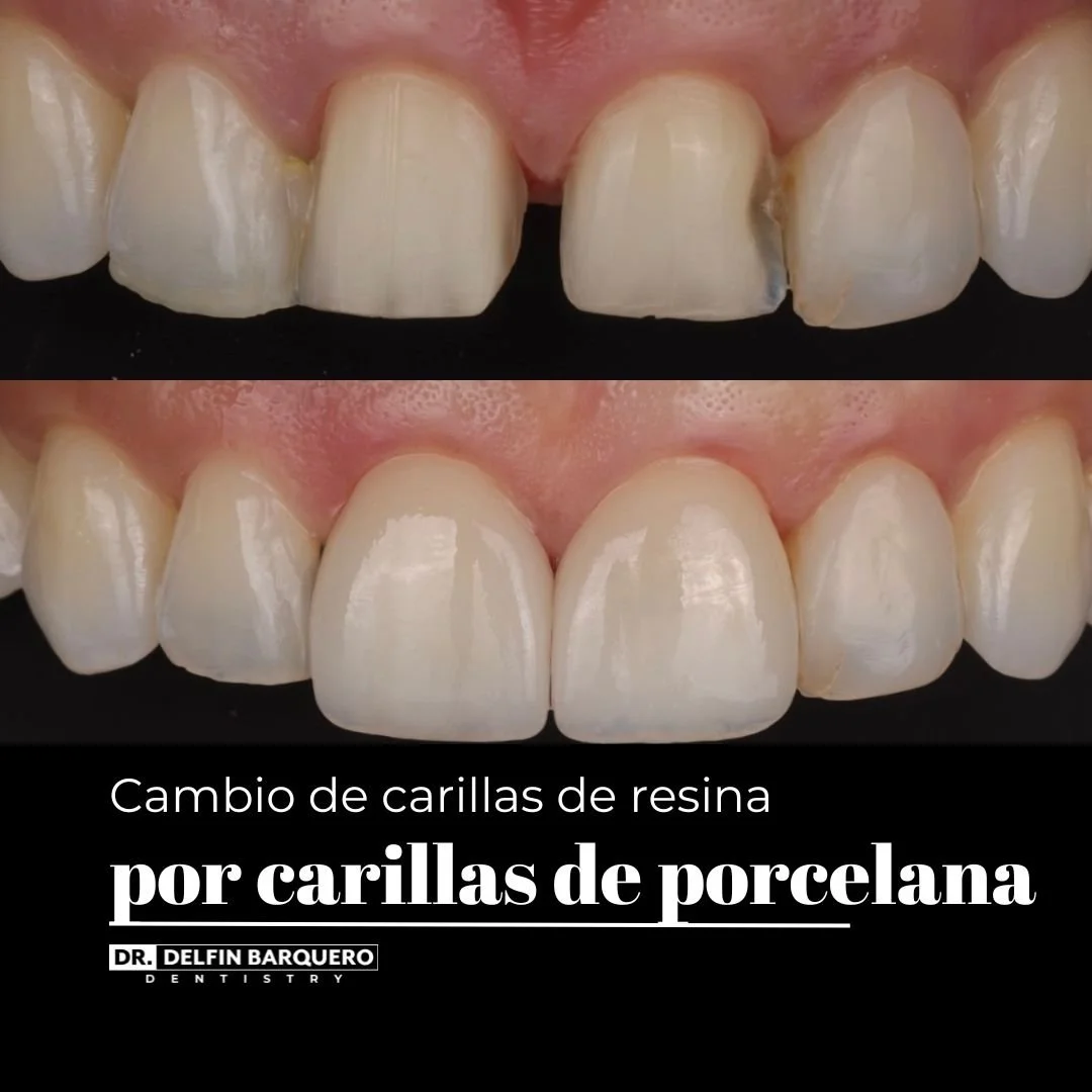 Composite Veneers Vs Pure Porcelain Dr. Delfin Barquero in Costa Rica