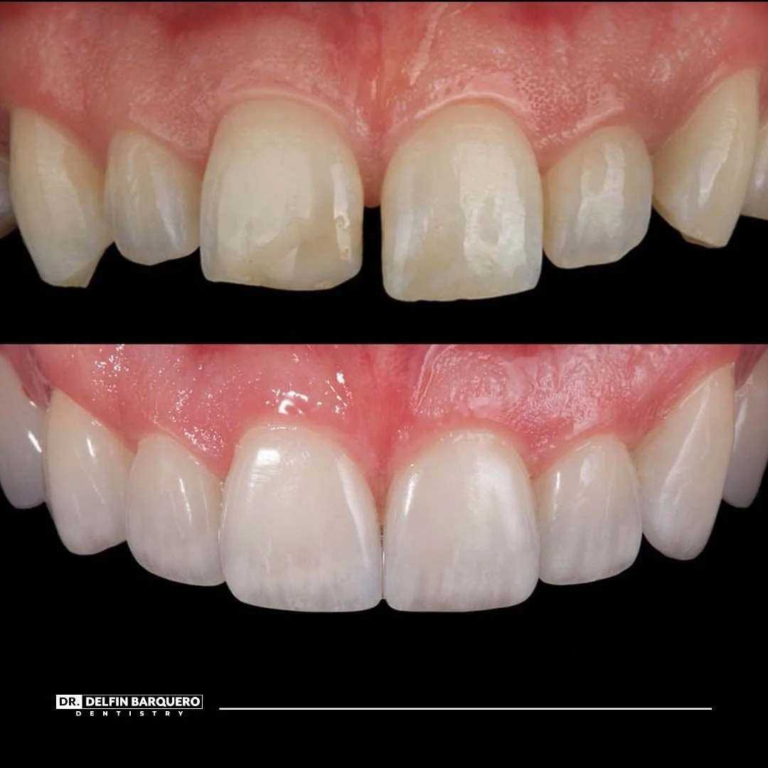 Pure Porcelain Veneers Dr. Delfin Barquero Costa Rica