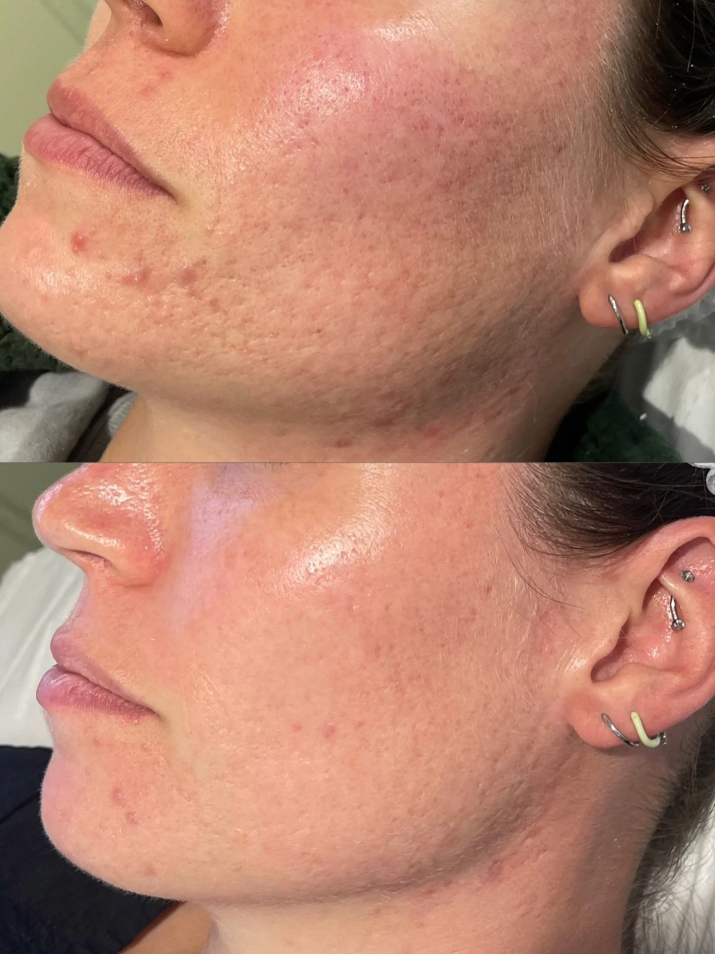5 sessions of microneedling ✨ 

my clients skin is smoother &amp; the deep scarring has softened with an overall improvement in her skin! 

results like this require commitment, correct spacing between treatments, and tailored aftercare, as collagen 