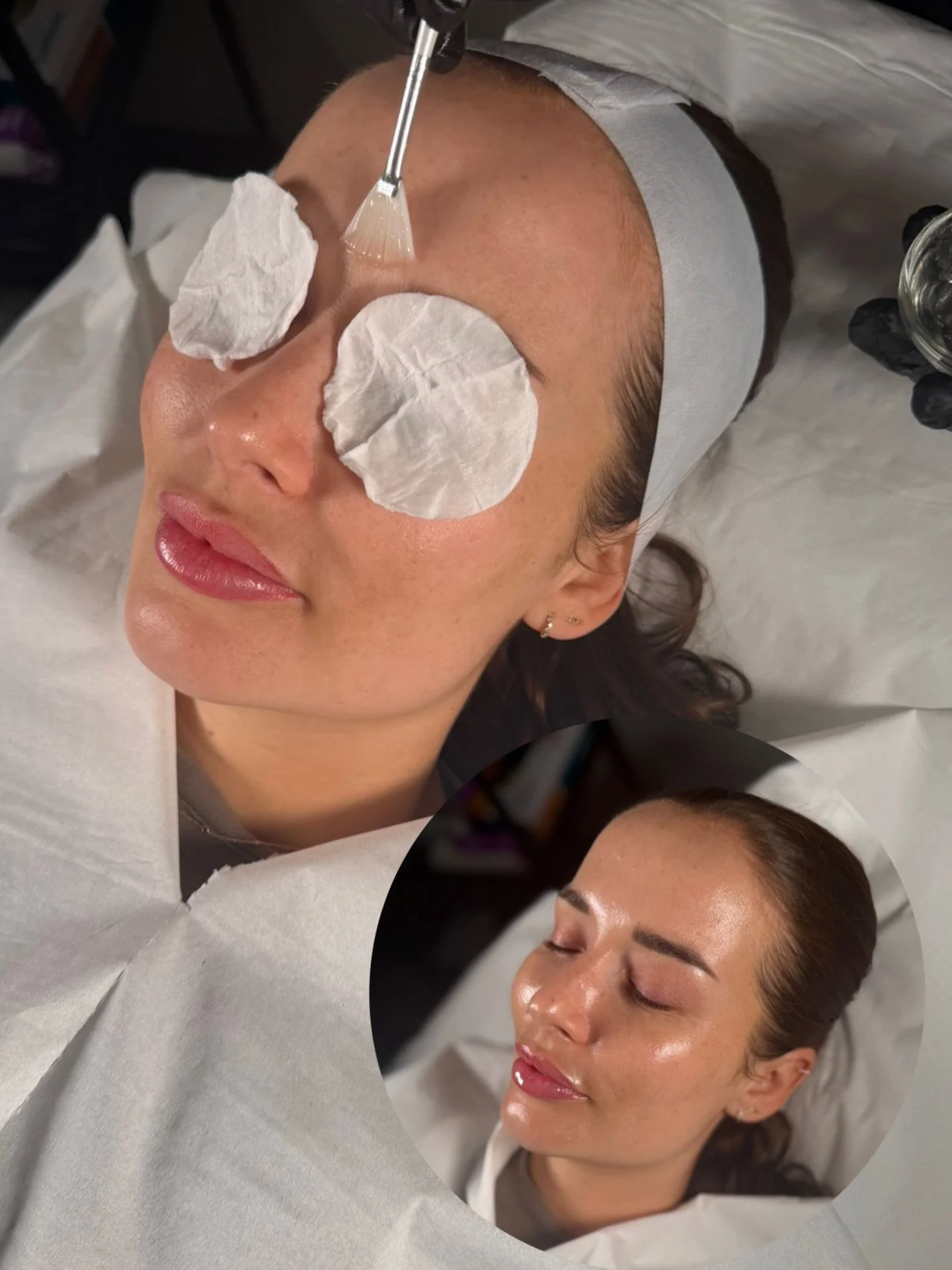 that chemical peel glow is real 🤩

no oil, no downtime, just glowy skin! can be done every 2/4 weeks with no peeling which is a bonus but still amazing results!

#chemicalpeel #chemicalpeels #chemicalpeelseason