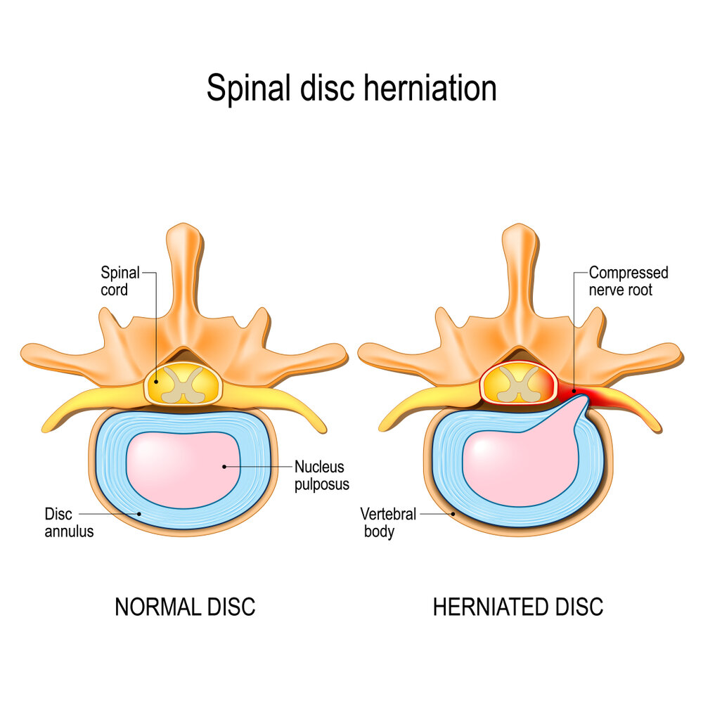 Treatment for Herniated Disc