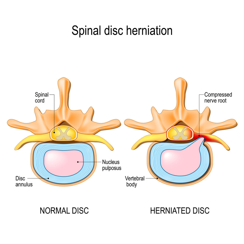 What You Need to Know About Herniated Disc Treatment?