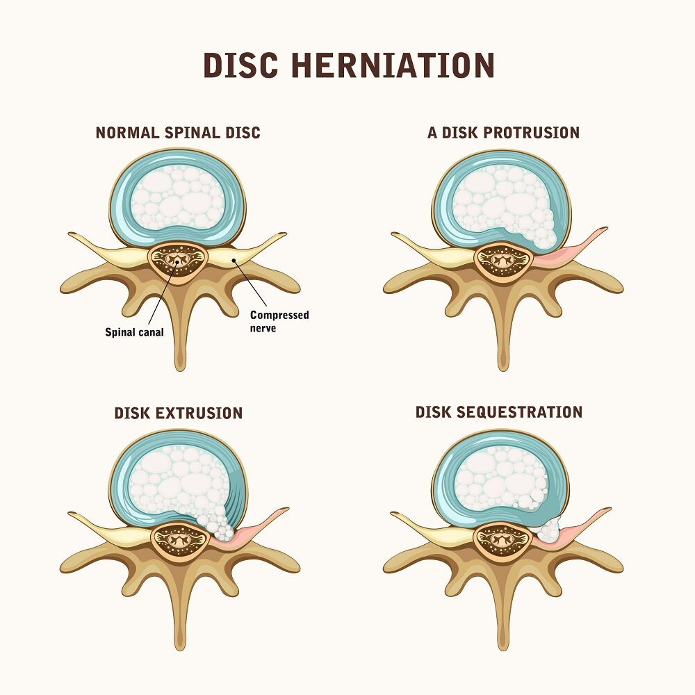 How Bulging Disc and Herniated Disc Differ?