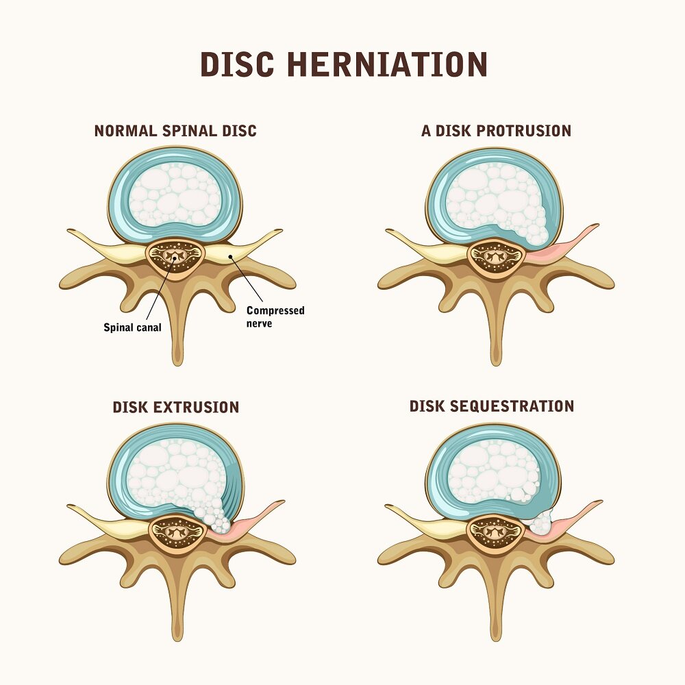 Herniated Disc Treatment