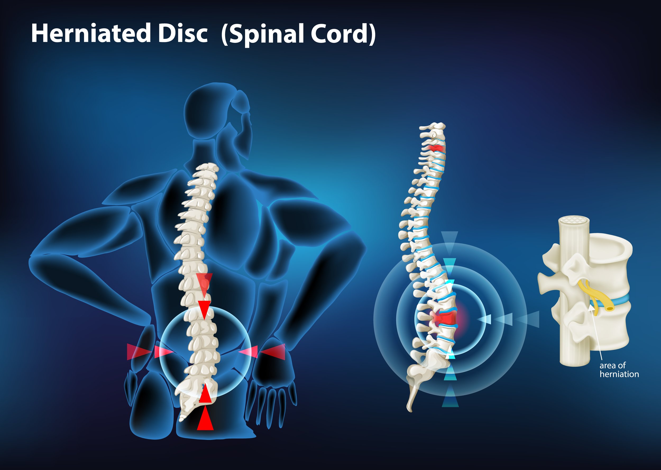 Clearing Herniated Disk Without Surgery: Is It Possible?