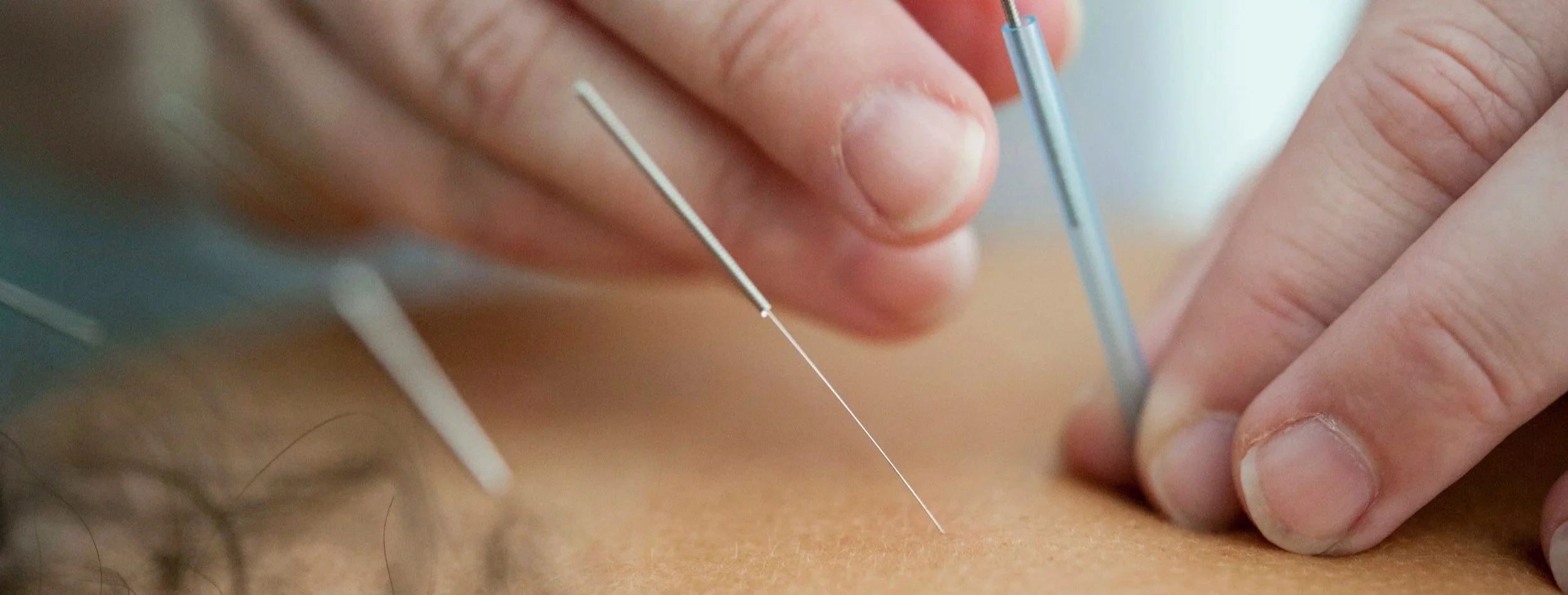 Acupuncture for Relief of Neck and Back Pain