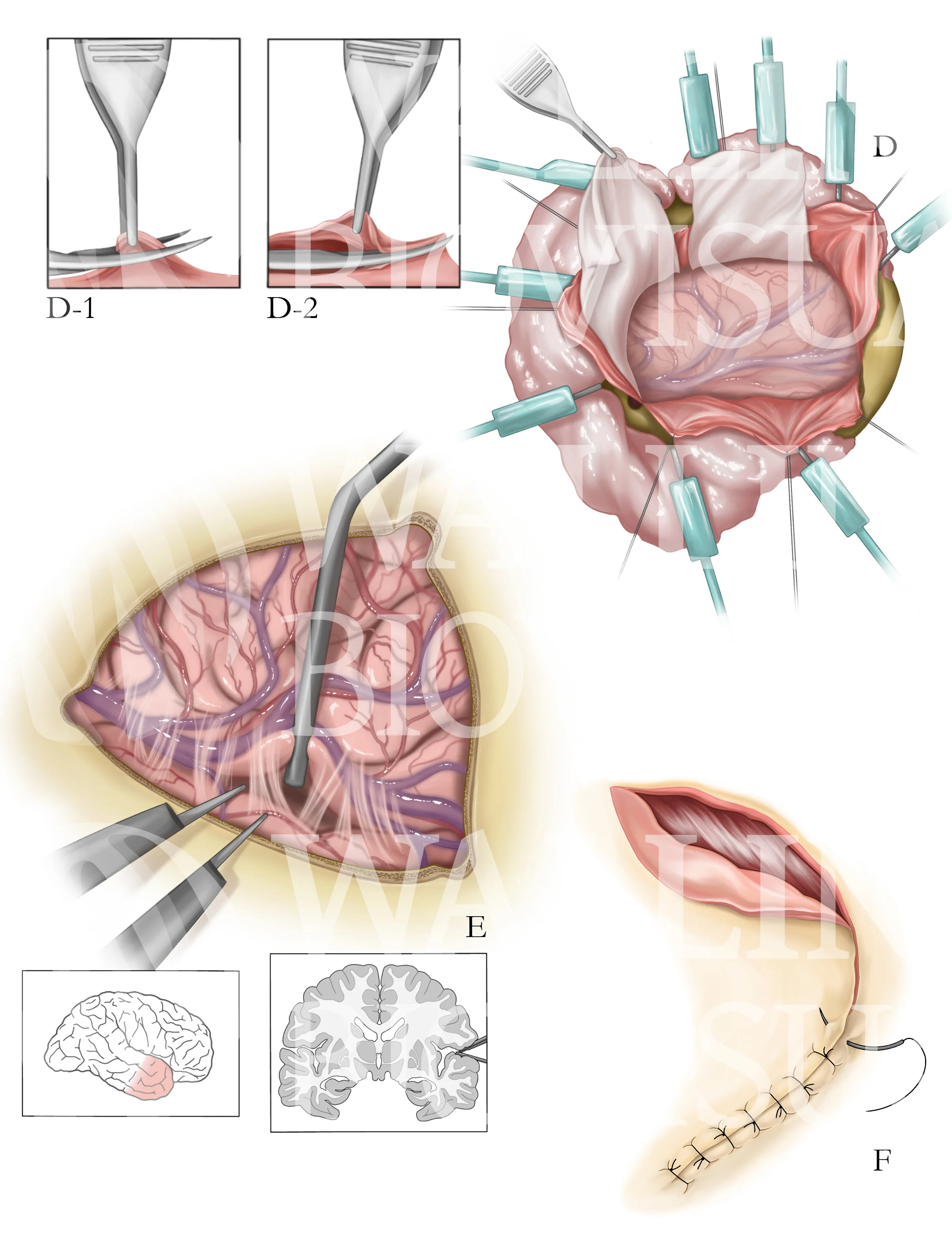 lobectomy-2.jpg