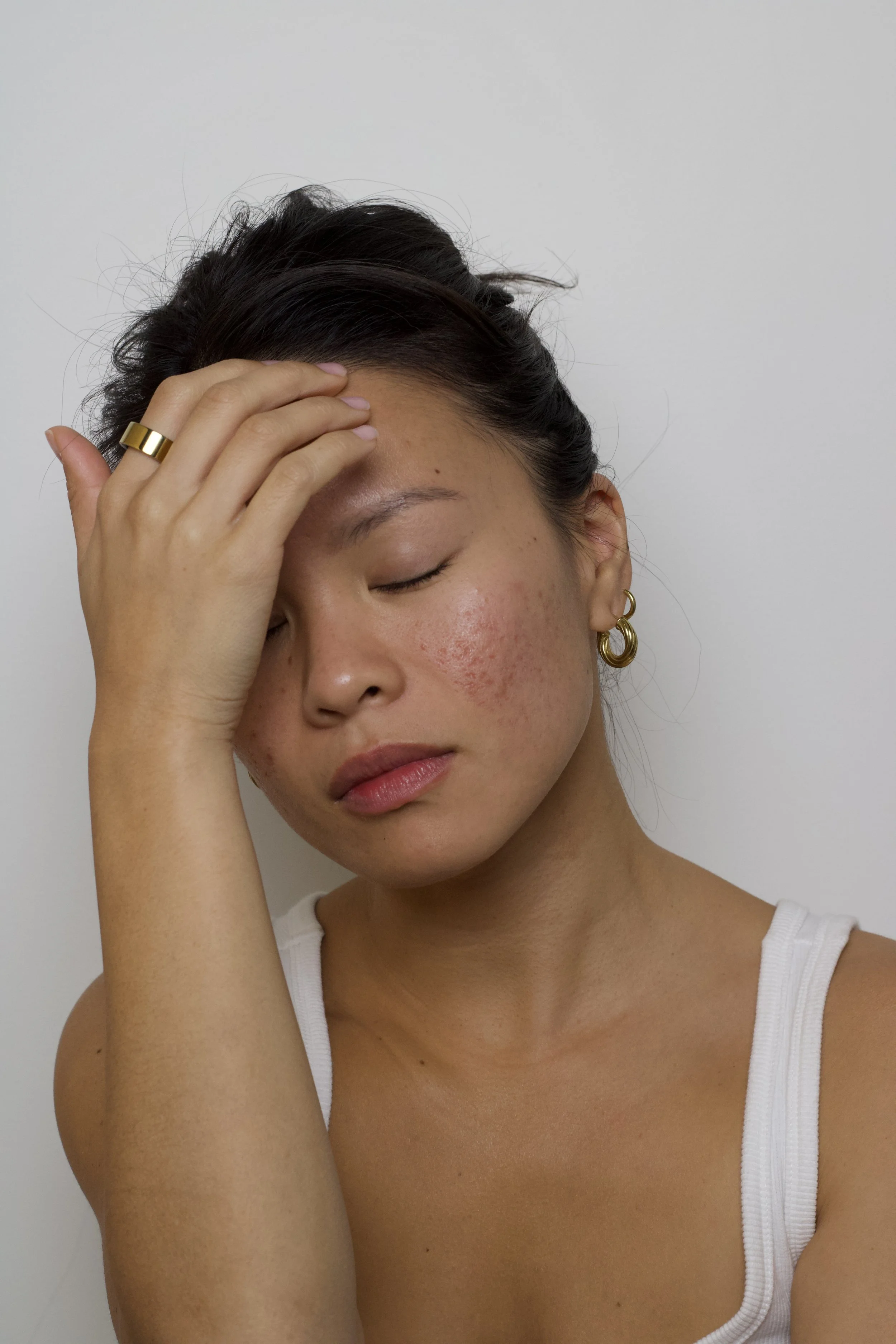 Detaching From Your Skin: A Gentle Guide to Avoiding Facial Dysmorphia (Especially When You Have Acne)