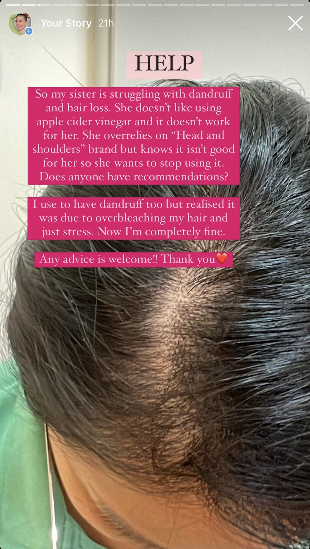 Dandruff and hairloss tips! — Liz Claire