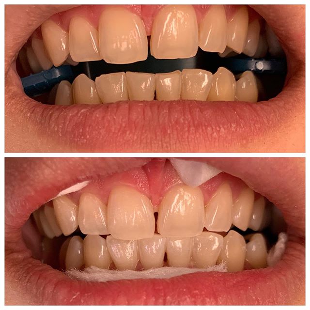 Very subtle results but no filter and no overhead light: ambient light only. Patient was happy and 5day strips also gifted to enhance results
