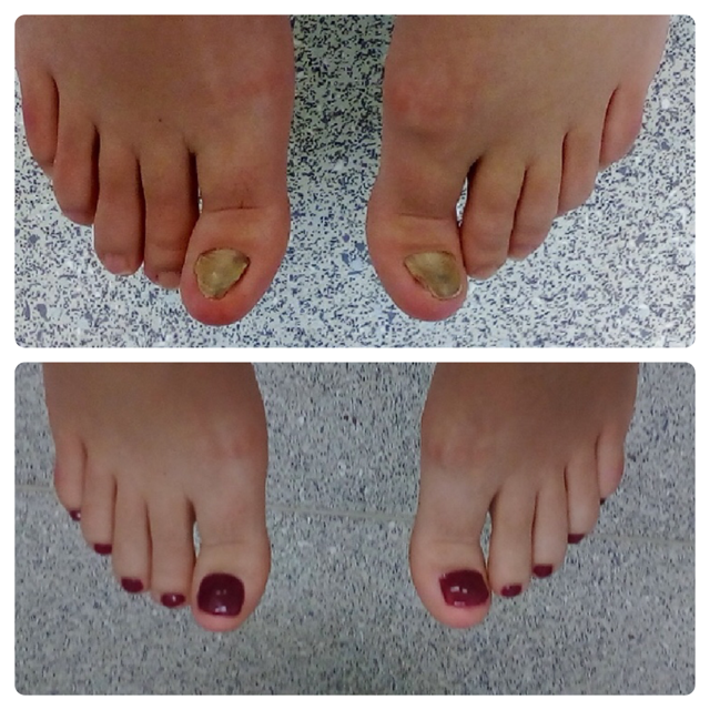 LCN Cosmetic Nail Reconstruction Futopia Medi Spa LCN Cosmetic Nail Reconstruction Futopia Medi Spa