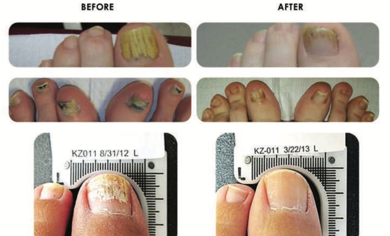 15 home remedies for toenail fungus | SingleCare