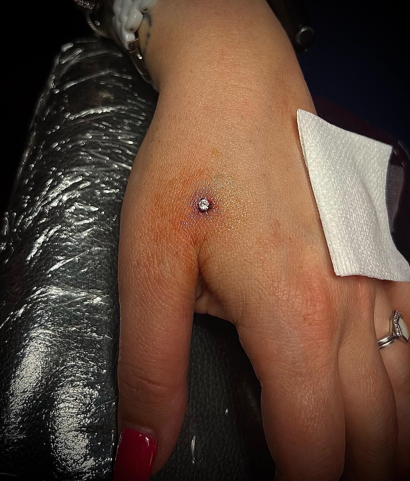 hand dermal done by @raezinnah