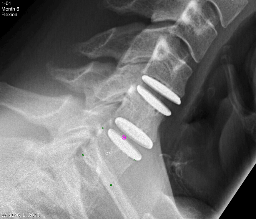 AxioMed_FreedomCervicalDisc_Animation.gif