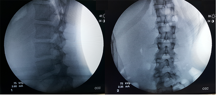 Bowen’s 40 degree spinal curvature seen through X-ray