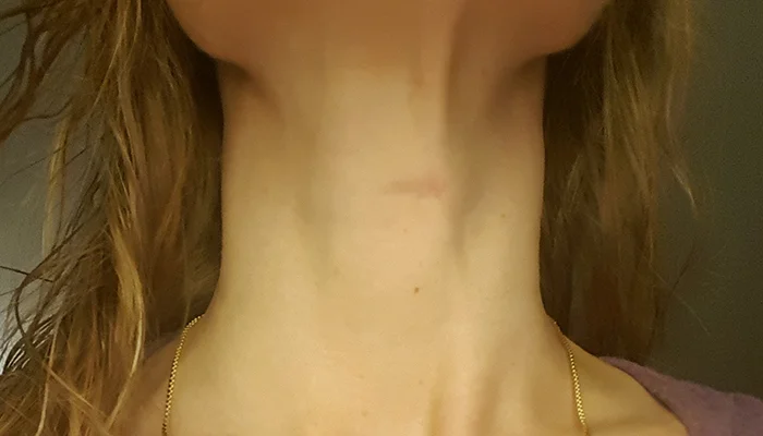 Option for Transverse Midline Incision and Other Factors That Determine Patient’s Decision to Have Cervical Spine Surgery