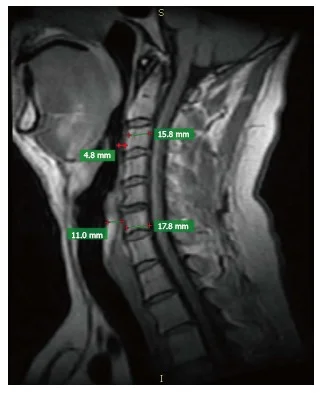 Preoperative radiograph showing retropharyngeal/prevertebral soft tissue at the level of C2 vertebral body and at the level of C6 vertebral body.