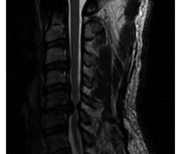 LI_Social_Blog_WhiteCordSyndrome-600x510.jpg