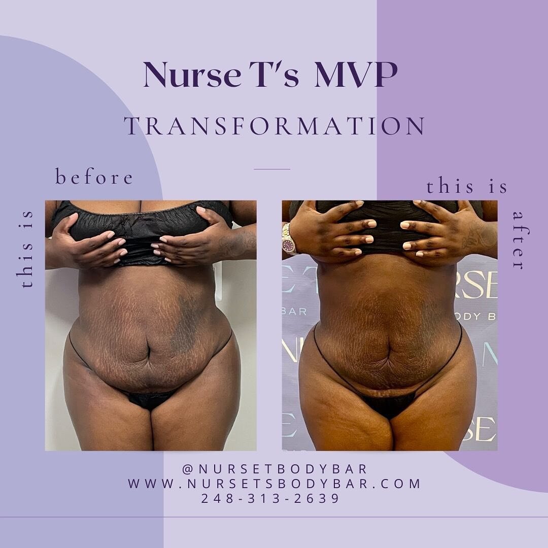 The difference 1 session can make! Don&rsquo;t be afraid to book, give us a call today!! Everyone who books a package during the month of May, no matter how far in advance will receive $250 off their post op package!

.
.
.
Call to book your  appoint